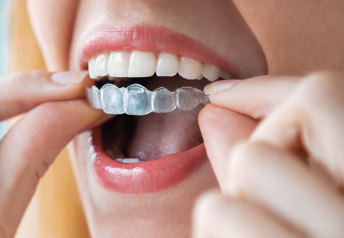 invisalign